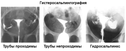 Гідросальпінкс на узі можливості дослідження (день циклу краще) Гідросальпінкс на узі можливості дослідження