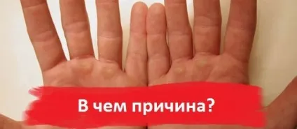 Гнучкий на долонях рук симптоми, причини, лікування (грибок долонях розвивається) Гнучкий на долонях рук симптоми, причини, лікування