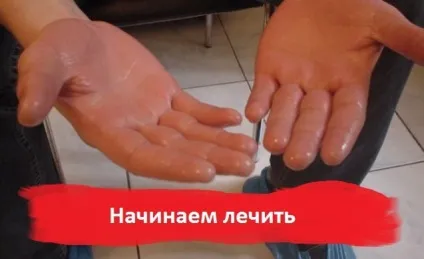 Гнучкий на долонях рук симптоми, причини, лікування (грибок долонях розвивається) Гнучкий на долонях рук симптоми, причини, лікування
