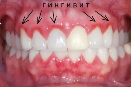 Гіпертрофічний гінгівіт - діагностика і лікування рідкісної хвороби (гіпертрофічний) Гіпертрофічний гінгівіт - діагностика і лікування рідкісної хвороби