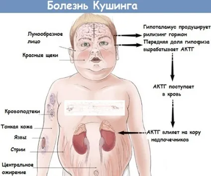 Гіперфункція і гіпофункція гіпофіза у дорослих як розвивається і проявляється (розвивається) Гіперфункція і гіпофункція гіпофіза у дорослих як розвивається і проявляється