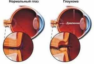 Очний тиск симптоми і лікування, як повинна бути норма