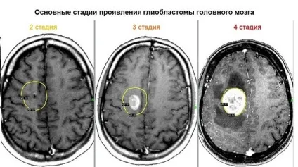 Гліобластома головного мозку симптоми, причини виникнення, лікування, як вмирають (причини) Гліобластома головного мозку симптоми, причини виникнення, лікування, як вмирають