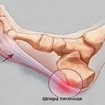 Горять ступні ніг - причини і лікування, народна медицина (причини) Горять ступні ніг - причини і лікування, народна медицина