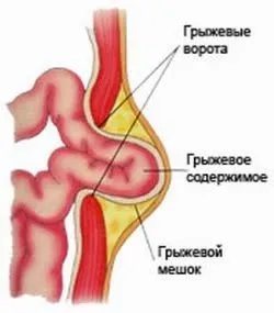 Грижа кишечника у жінок симптоми і причини виникнення (кишечника) Грижа кишечника у жінок симптоми і причини виникнення
