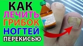 Грибок нігтя на великому пальці ноги лікування народні засоби - програми - на нігтях рук грибок (нігтя) Грибок нігтя на великому пальці ноги лікування народні засоби - програми - на нігтях рук грибок