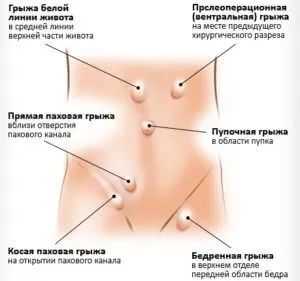 Грижа кишечника у жінок симптоми і причини виникнення (причини) Грижа кишечника у жінок симптоми і причини виникнення