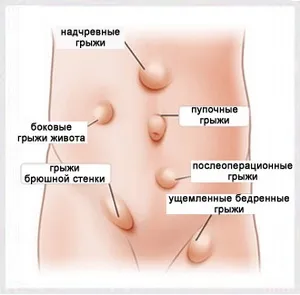 Грижа кишечника у дорослих види, симптоми і способи лікування (грижа) Грижа кишечника у дорослих види, симптоми і способи лікування