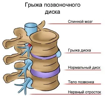 Грижа міжхребцевих дисків - лікування, профілактика, наслідки (наслідки) Грижа міжхребцевих дисків - лікування, профілактика, наслідки