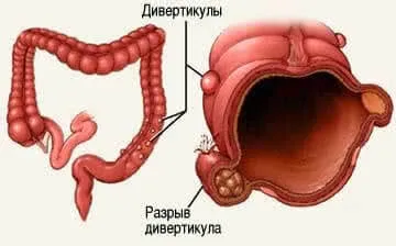 Грижа кишечника у жінок симптоми і причини виникнення (жінок) Грижа кишечника у жінок симптоми і причини виникнення