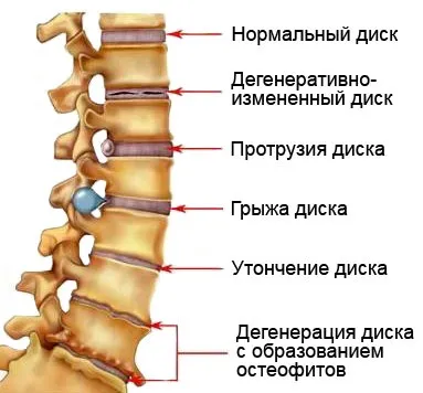 Грудний відділ хребта спондильоз, що це таке, симптоми, лікування (спондильоз грудного відділу хребта симптоми) Грудний відділ хребта спондильоз, що це таке, симптоми, лікування