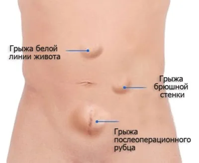 Грижа кишечника у жінок симптоми і причини виникнення (симптоми) Грижа кишечника у жінок симптоми і причини виникнення