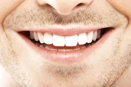Hollywood smile