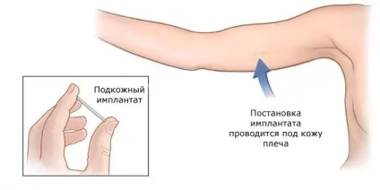 Імплант в руку протизаплідний що потрібно знати (імплант) Імплант в руку протизаплідний що потрібно знати