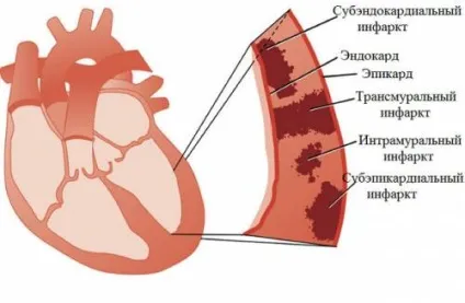 Інфаркт міокарда на ЕКГ ознаки і діагностика, стадії, розшифровка (відсутності електричної активності) Інфаркт міокарда на ЕКГ ознаки і діагностика, стадії, розшифровка