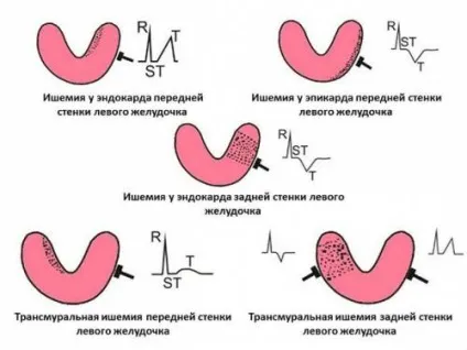 Інфаркт міокарда на ЕКГ ознаки і діагностика, стадії, розшифровка (інфаркт) Інфаркт міокарда на ЕКГ ознаки і діагностика, стадії, розшифровка