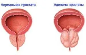 Інструкція по застосуванню препарату Фокусин при простатиті, курс лікування і скільки часу пити, (препарату) Інструкція по застосуванню препарату Фокусин при простатиті, курс лікування і скільки часу пити,