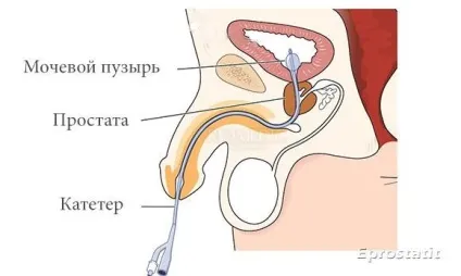Інстиляція уретри у чоловіків - як робити, коли, кому і для чого здоров'я інфо