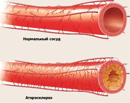 Інсульт ішемічний, ліва сторона (лівостороннього ішемічного інсульту) Інсульт ішемічний, ліва сторона