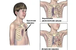 Викривлення грудної клітини причини і як виправити (викривлення) Викривлення грудної клітини причини і як виправити