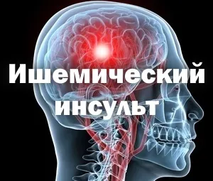 Ішемічний інсульт ліва сторона, наслідки та прогноз на одужання (ішемічний) Ішемічний інсульт ліва сторона, наслідки та прогноз на одужання