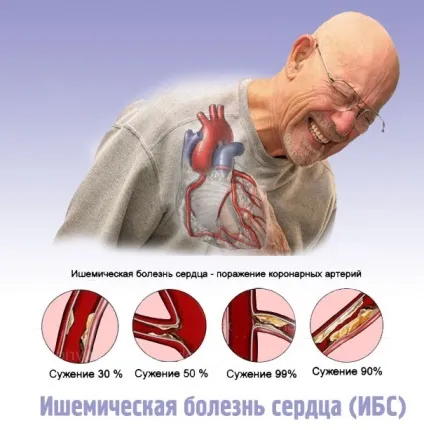 Ішемічна хвороба серця симптоми, диференціальна діагностика, лікування, перші ознаки ІХС (ішемічна) Ішемічна хвороба серця симптоми, диференціальна діагностика, лікування, перші ознаки ІХС