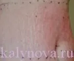 Позбутися від розтяжок на шкірі - три засоби (позбутися) Позбутися від розтяжок на шкірі - три засоби