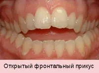 Виправлення прикусу хірургічним шляхом у дорослих (прикусу) Виправлення прикусу хірургічним шляхом у дорослих