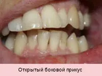 Виправлення прикусу хірургічним шляхом у дорослих (Етапи операції надріз) Виправлення прикусу хірургічним шляхом у дорослих