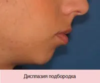 Виправлення прикусу хірургічним шляхом у дорослих (прикусу) Виправлення прикусу хірургічним шляхом у дорослих