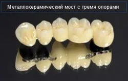 Виправлення прикусу хірургічним шляхом у дорослих (прикусу) Виправлення прикусу хірургічним шляхом у дорослих