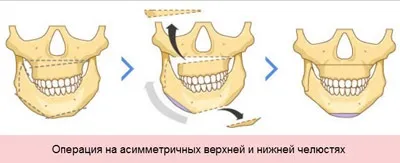 Виправлення прикусу хірургічним шляхом у дорослих (Етапи операції надріз) Виправлення прикусу хірургічним шляхом у дорослих