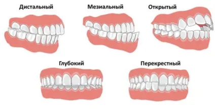 Виправлення кривих зубів - ефективні способи виправлення кривизни зубів (виправити криві зуби) Виправлення кривих зубів - ефективні способи виправлення кривизни зубів