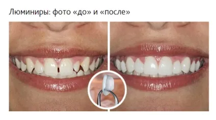 Виправлення кривих зубів - ефективні способи виправлення кривизни зубів (зубів) Виправлення кривих зубів - ефективні способи виправлення кривизни зубів