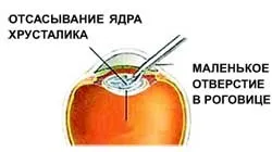 Вилікуватися від сліпоти, наука і життя (історія техніки) Вилікуватися від сліпоти, наука і життя