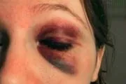 Як швидко прибрати синець як запобігти утворенню синяка і гематоми (прибрати) Як швидко прибрати синець як запобігти утворенню синяка і гематоми