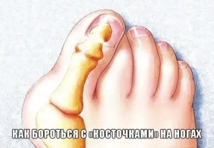 Як боротися з «кісточками» на ногах (великий палець ноги) Як боротися з «кісточками» на ногах