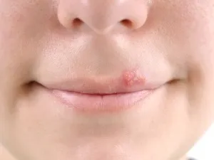 Яким шляхом передається герпес на губах (шляхом) Яким шляхом передається герпес на губах