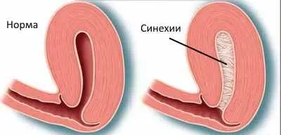 Які гінекологічні маніпуляції можуть викликати аменорею