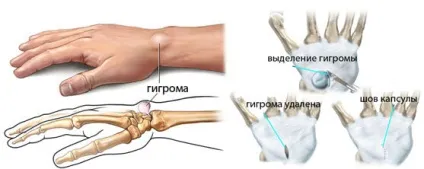 Як позбутися від шишок на пальцях ефективне лікування (лікування) Як позбутися від шишок на пальцях ефективне лікування