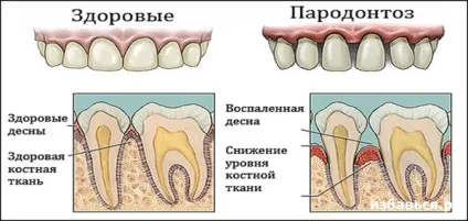 Як позбутися від пародонтозу (капілярів покращує тканинної) Як позбутися від пародонтозу
