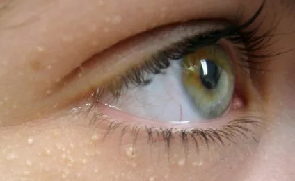 Як позбутися від міліуми - нова косметологія (брів новітня процедура Кул-епіляція) Як позбутися від міліуми - нова косметологія