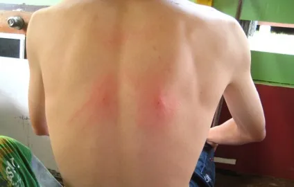 Як позбутися від плям після укусу комара