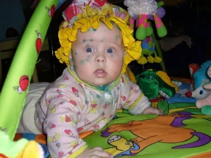 Як позбутися від слідів вітрянки (слід) Як позбутися від слідів вітрянки