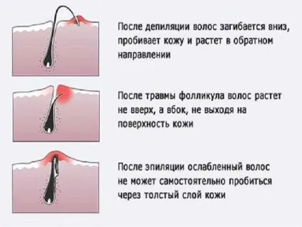 Як позбутися від врослого волосся на ногах в домашніх умовах (домашніх) Як позбутися від врослого волосся на ногах в домашніх умовах