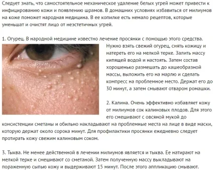 Як позбутися від міліуми - нова косметологія (Кул-епіляція новомодний спосіб Серединний) Як позбутися від міліуми - нова косметологія