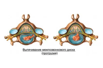 Як лікувати протрузию поперекового, шийного, грудного і крижового відділів хребта