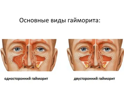 Як лікувати гайморит без проколу чи можна, сучасне, гострий, хронічний, гнійний, скільки лікується (проколу) Як лікувати гайморит без проколу чи можна, сучасне, гострий, хронічний, гнійний, скільки лікується