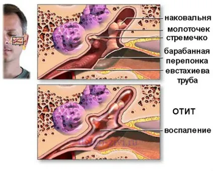 Як лікувати хронічний отит підкажуть лікарі і народні засоби (народні) Як лікувати хронічний отит підкажуть лікарі і народні засоби