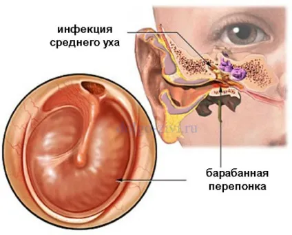 Як лікувати хронічний отит підкажуть лікарі і народні засоби (отит) Як лікувати хронічний отит підкажуть лікарі і народні засоби
